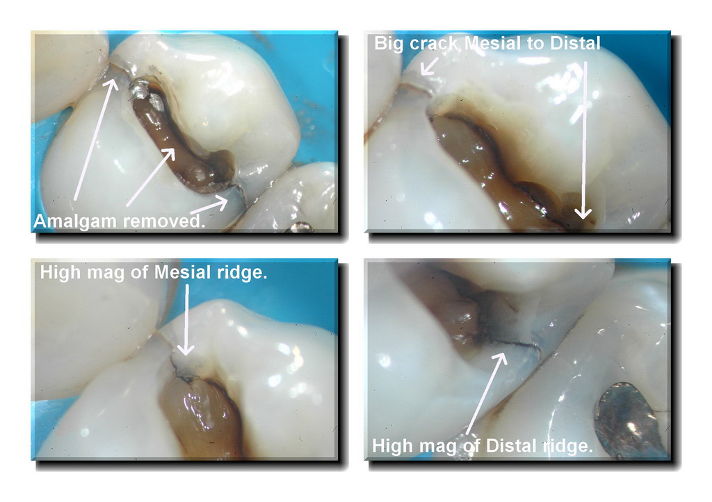 Cracked tooth pg 2_resize.jpg